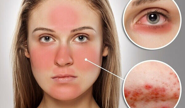 Lupus ban đỏ là bệnh gì