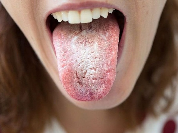 Lưỡi trắng là bệnh gì